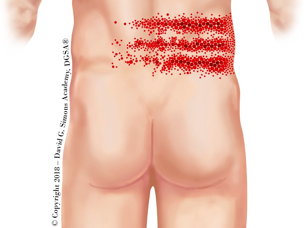 Referred pain pattern of the rectus abdominis muscle